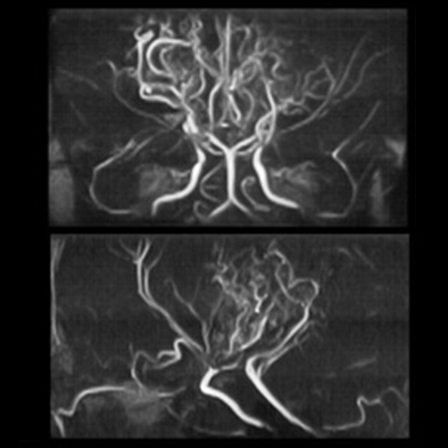 図2：核磁気共鳴血管撮影（MRA）上：正面像、下：側面像
